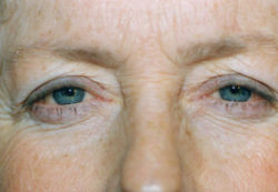 Combination Surgeries (eyelid lift and other)