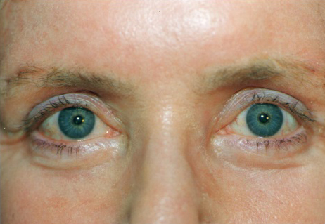 Combination Surgeries (eyelid lift and other)