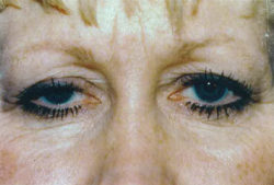 Combination Surgeries (eyelid lift and other)