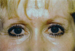 Combination Surgeries (eyelid lift and other)