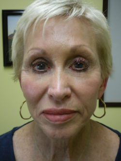 Combination Surgeries (eyelid lift and other)