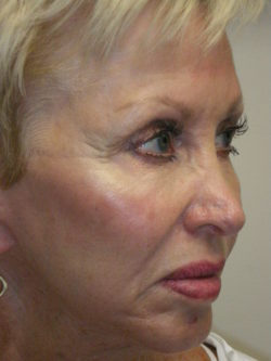 Combination Surgeries (eyelid lift and other)