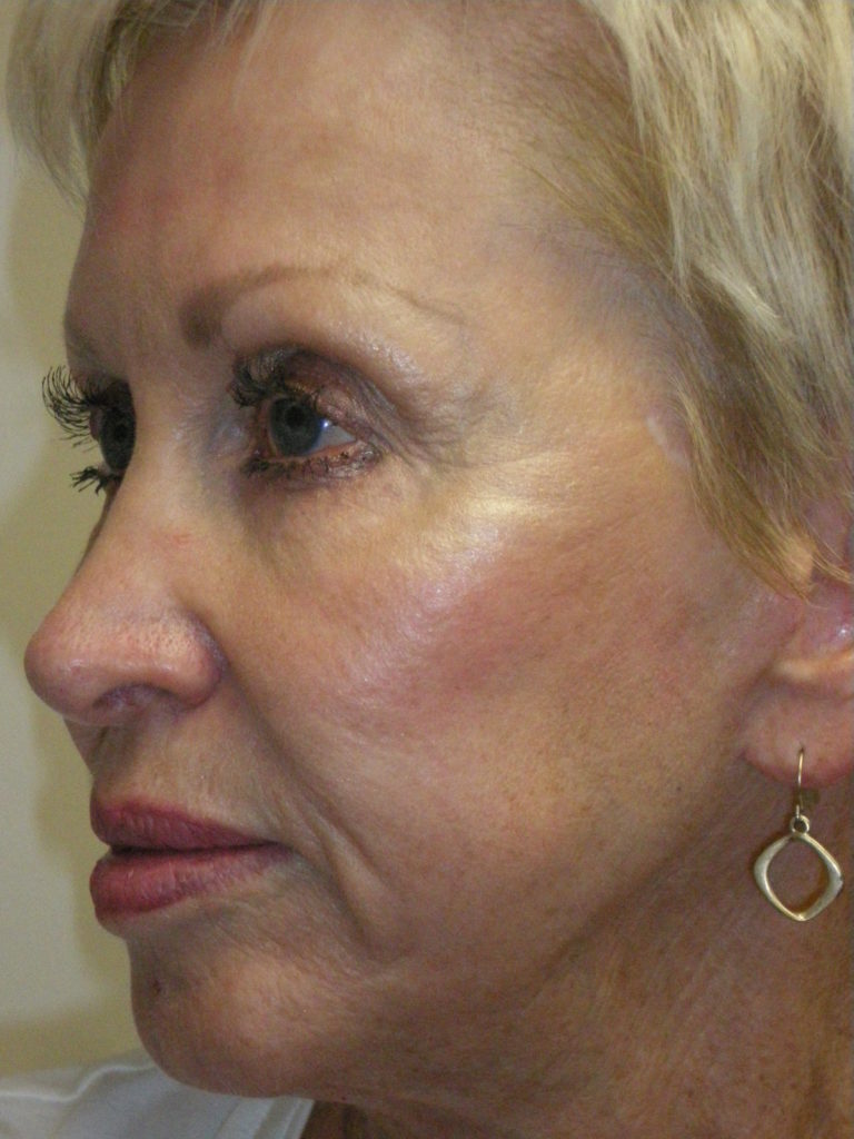 Combination Surgeries (eyelid lift and other)