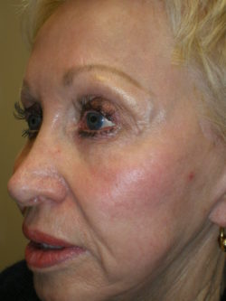 Combination Surgeries (eyelid lift and other)