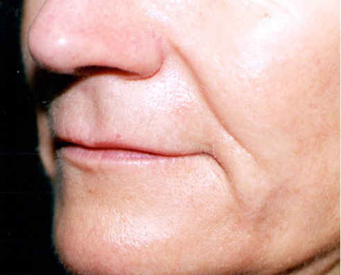 Filler (wrinkles/lines)