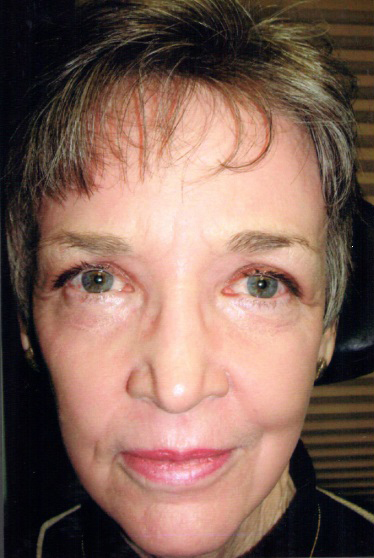 CO2 Laser Resurfacing (wrinkle/line reduction) Case 1543 After Photo CO2 Laser Resurfacing (wrinkle/line reduction)