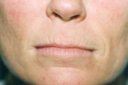 CO2 Laser Resurfacing (wrinkle/line reduction)