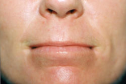 CO2 Laser Resurfacing (wrinkle/line reduction)