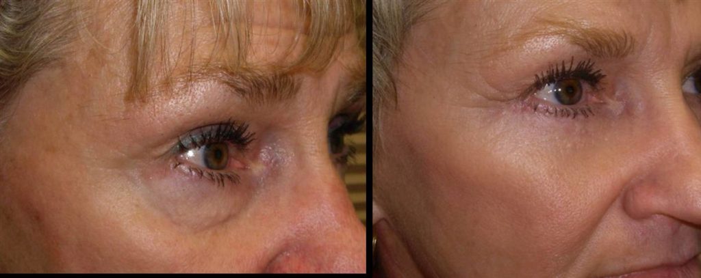 Blepharoplasty With Fat Transfer Image of woman before and after Fat transfer