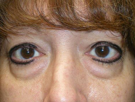 Lower Lid Blepharoplasty (lower eyelid eyelift)