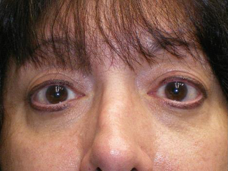 Lower Lid Blepharoplasty (lower eyelid eyelift)