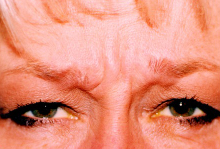 Botox (wrinkle reduction)