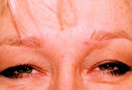 Botox (wrinkle reduction)