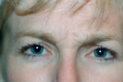 Botox (wrinkle reduction)