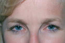 Botox (wrinkle reduction)