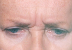 Botox (wrinkle reduction)