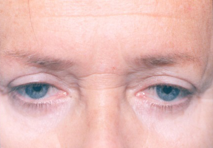 Botox (wrinkle reduction)