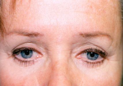 Botox (wrinkle reduction)