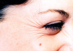 Botox (wrinkle reduction)