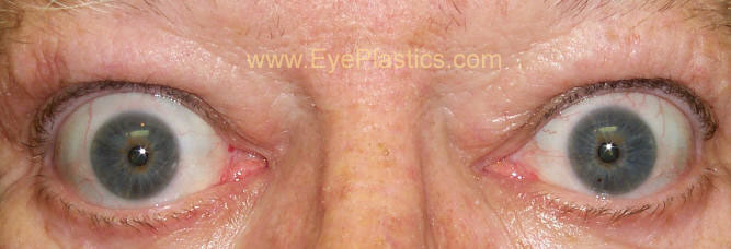 Photo of a patient with Graves' disease