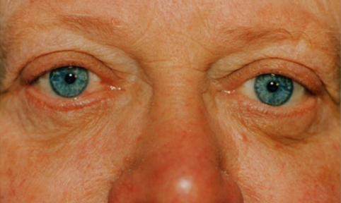 Lower Lid Blepharoplasty (lower eyelid eyelift)
