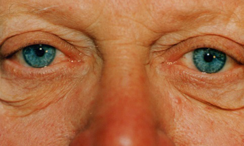 Lower Lid Blepharoplasty (lower eyelid eyelift)