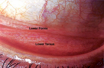 Symblepharon 1 Cosmetic & Reconstructive Facial Eyelid & Orbital surgery @ Eye Plastics.
