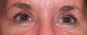 Cosmetic eyelid surgery, Blepharoplasty, Eyelift