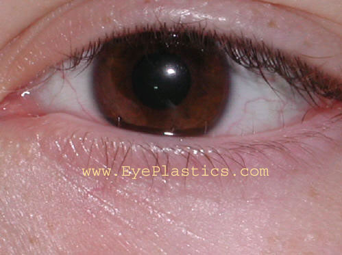 Trichiasis - Lashes pointing to the eye