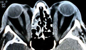 Graves’ Disease 3 Hypothyroidism