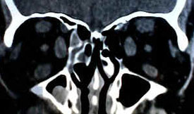 Graves’ Disease 4 Hypothyroidism