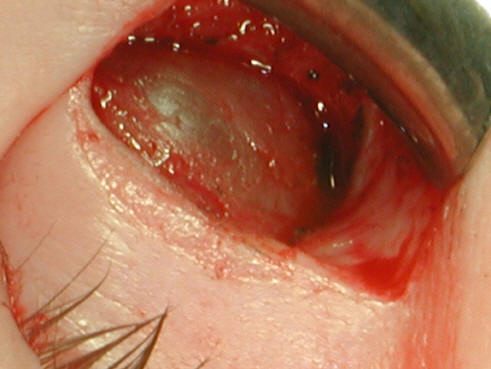 Orbital Tumors - Lacrimal Sac