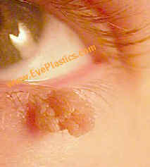 papilloma eyelid