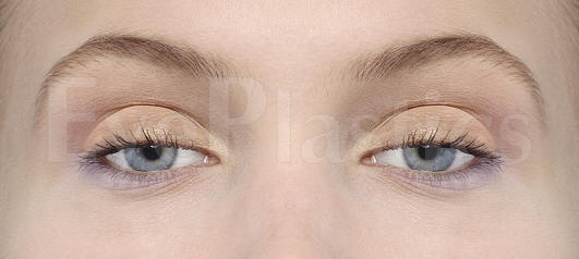 Ptosis & Droopy Eyelid Patient