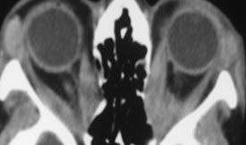 Graves’ Disease 5 Hypothyroidism