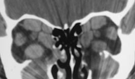 Graves’ Disease 6 Hypothyroidism