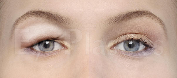 Ptosis & Droopy Eyelid Patient