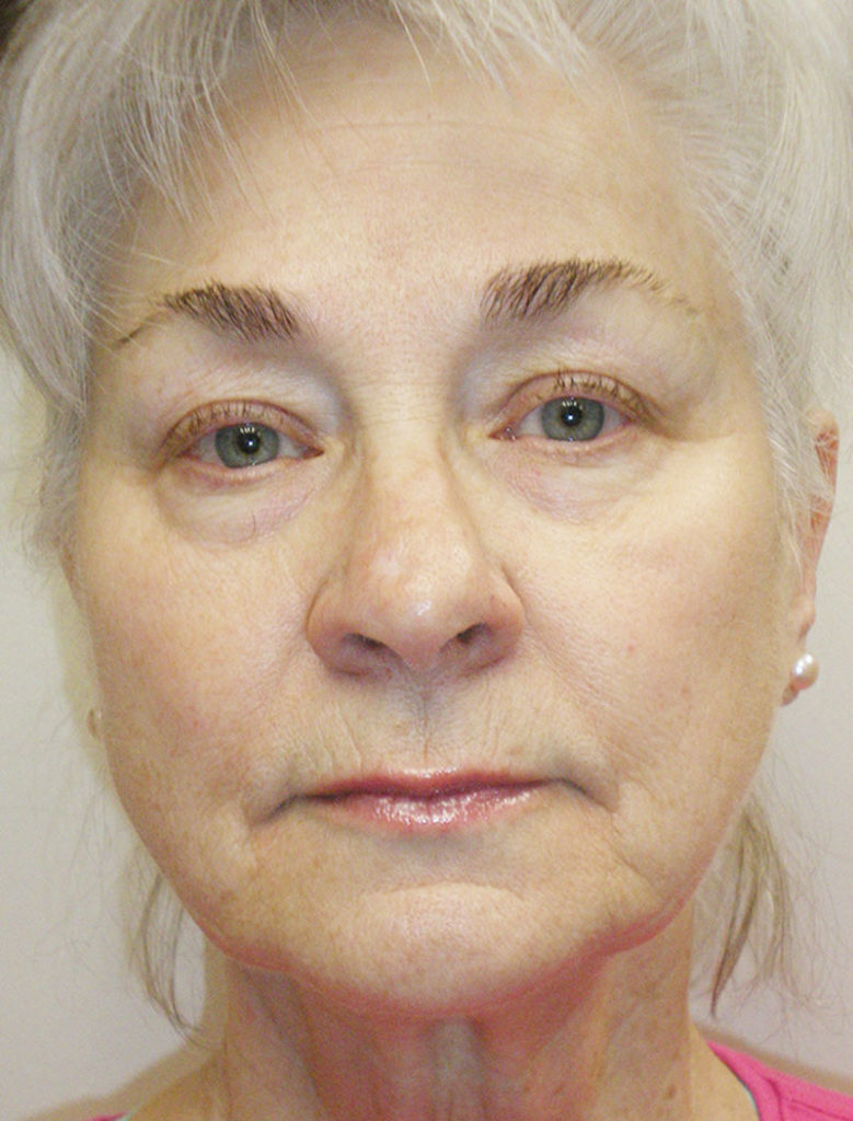 Face/Neck Lift