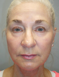 Face/Neck Lift