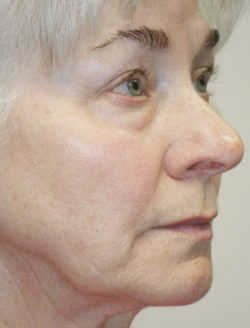 Face/Neck Lift