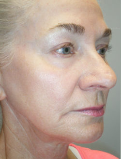 Face/Neck Lift