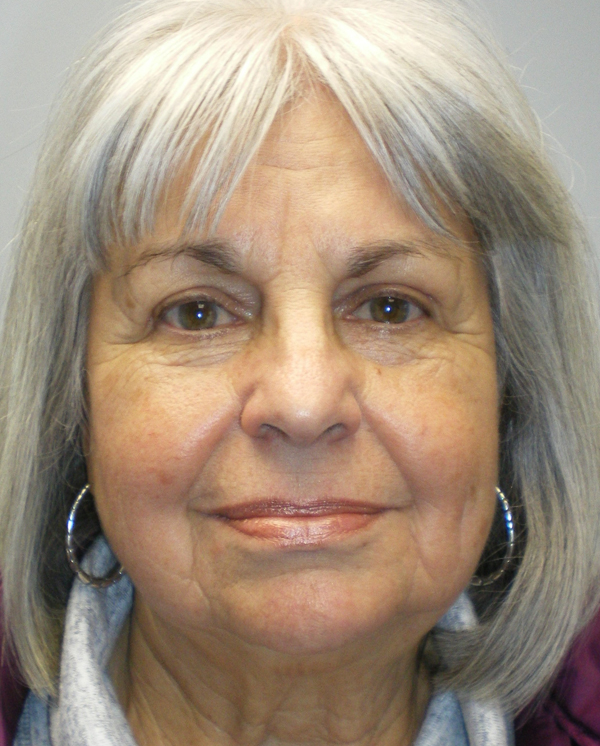 After Brow/Forehead Lift After Brow/Forehead Lift
