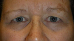 Upper Lid Blepharoplasty (upper eyelid lift)