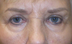 Upper Lid Blepharoplasty (upper eyelid lift)