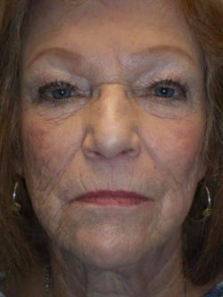 Upper Lid Blepharoplasty (upper eyelid lift)