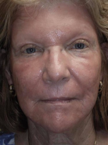 Upper Lid Blepharoplasty (upper eyelid lift)