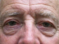 Upper Lid Blepharoplasty (upper eyelid lift)