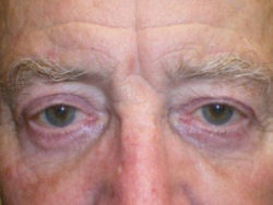 Upper Lid Blepharoplasty (upper eyelid lift)