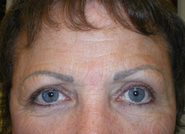 Upper Lid Blepharoplasty (upper eyelid lift)