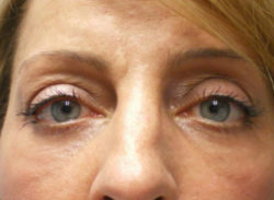 Lower Lid Blepharoplasty (lower eyelid eyelift)